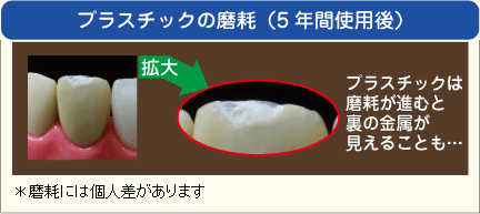 プラスチックの磨耗