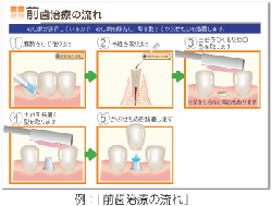 前歯治療の流れ